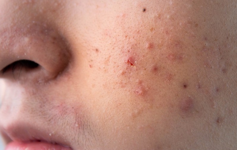 Facial scarring that may require future scar revision care