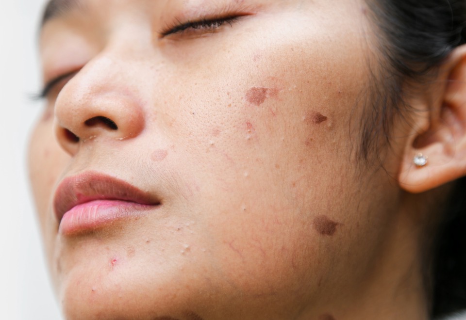Visible facial scarring after a dog bite injury